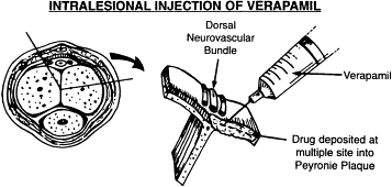 verapamil e doença de peyronie