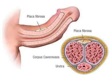 Doença de Peyronie, curvatura peniana
